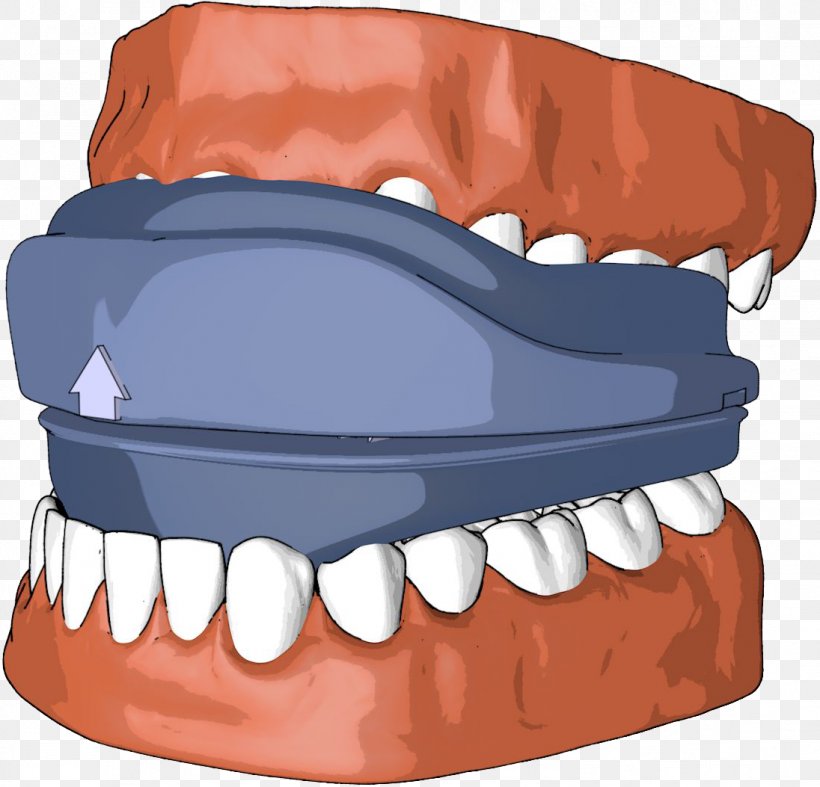 Snoring Sleep Apnea Mouthguard Dentistry, PNG, 1096x1053px, Watercolor, Cartoon, Flower, Frame, Heart Download Free