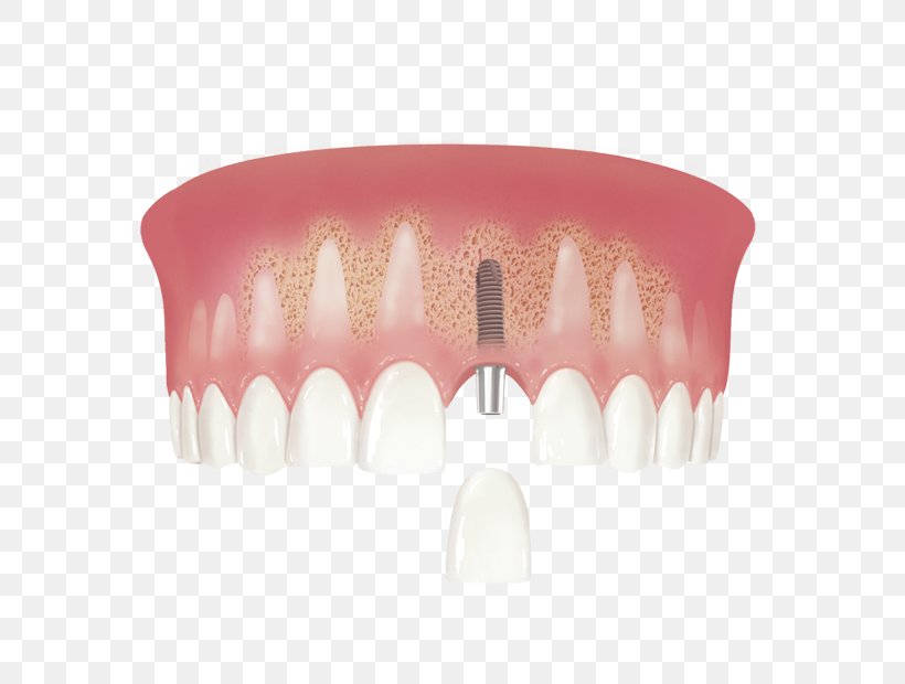 Human Tooth Dental Implant Implantology, PNG, 800x620px, Tooth, Crown, Dental Implant, Dentistry, Dentures Download Free