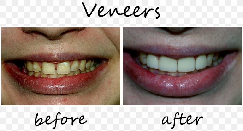 Tooth Veneer Orthodontics Dentistry, PNG, 1200x651px, Tooth, Chin, Clear Aligners, Cosmetic Dentistry, Crown Download Free