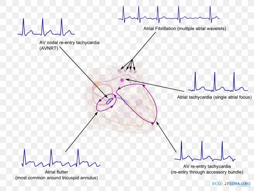 Supraventricular Tachycardia Heart Arrhythmia Atrial Fibrillation, PNG, 1000x750px, Watercolor, Cartoon, Flower, Frame, Heart Download Free