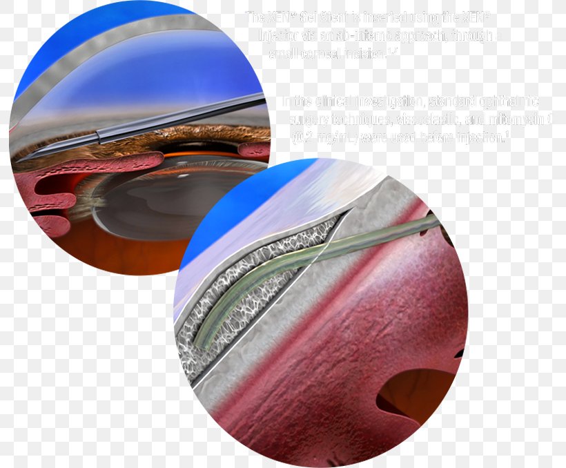 Minimally Invasive Glaucoma Surgery Glaucoma Medication, PNG, 793x678px, Surgery, Complication, Eyewear, Glaucoma, Glaucoma Medication Download Free