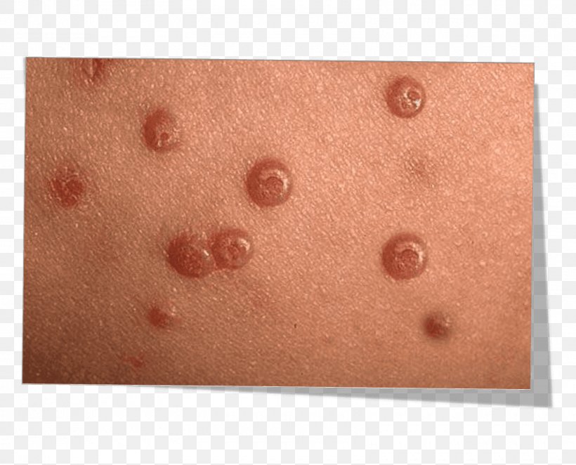 Molluscum Contagiosum Skin Wheal Pediatrics Infectious Disease Png