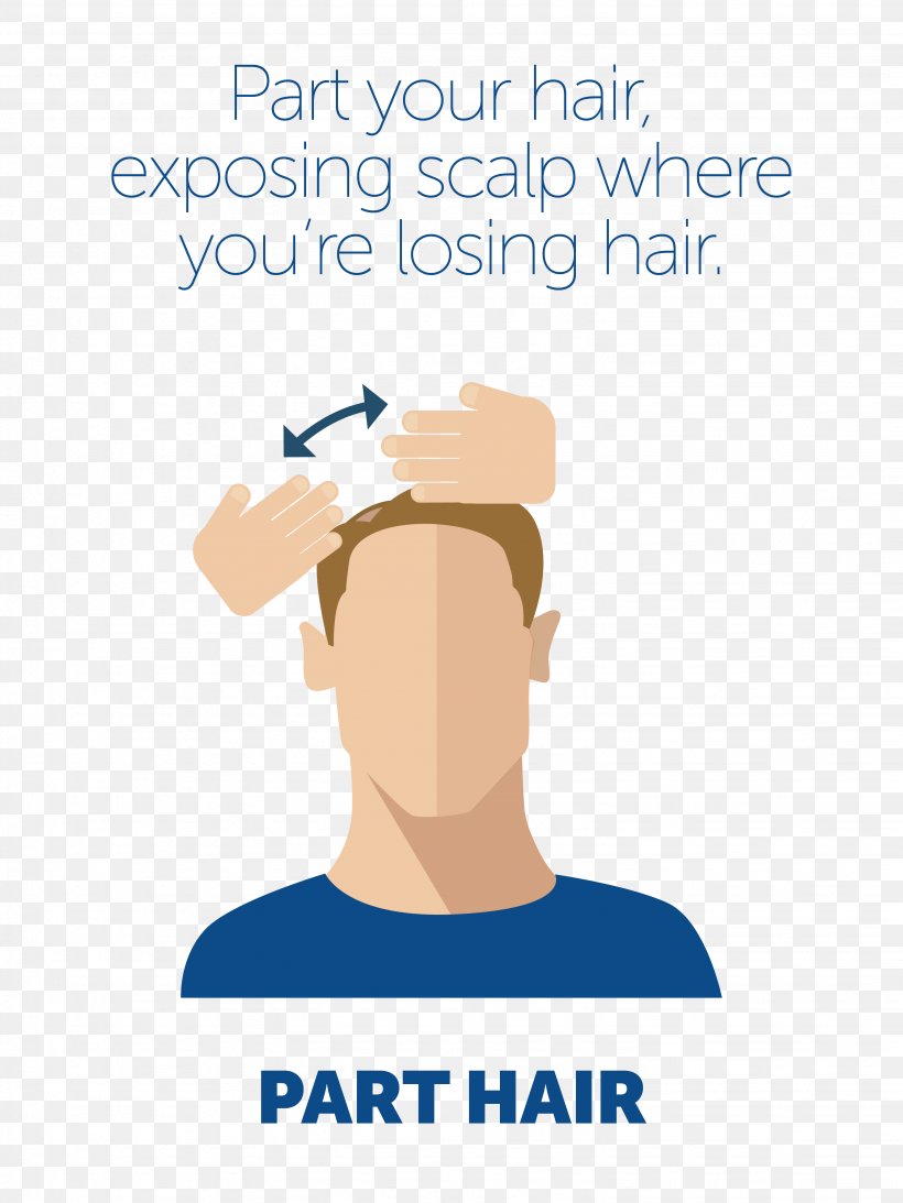 Minoxidil Scalp Management Of Hair Loss, PNG, 3067x4089px, Minoxidil, Area, Black Hair, Brand, Communication Download Free