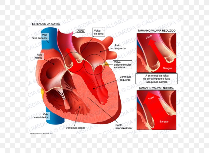 Mitral Valve Stenosis Mitral Insufficiency Aorta Aortic Insufficiency, PNG, 600x600px, Watercolor, Cartoon, Flower, Frame, Heart Download Free