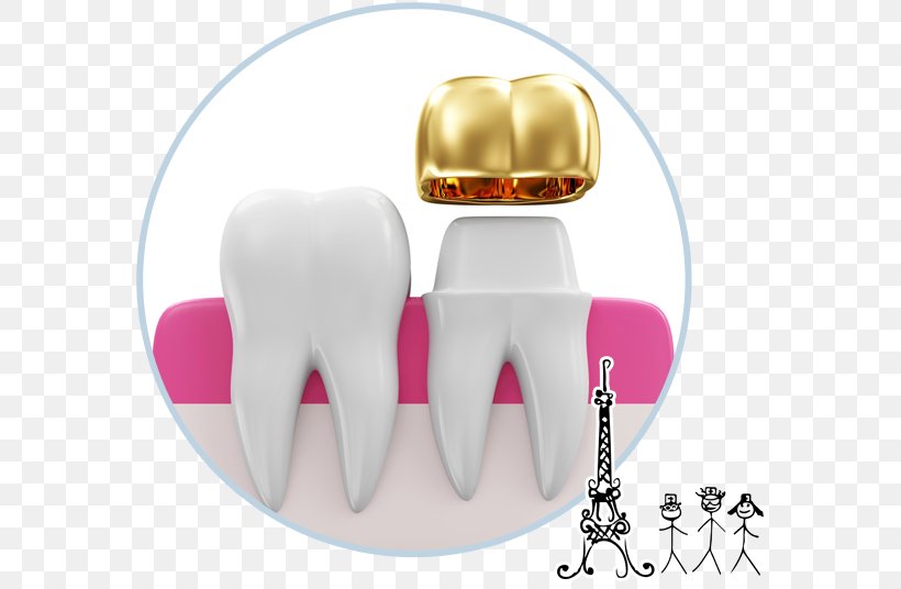 Tooth Crown Dentistry Prosthodontics Dental Implant, PNG, 585x536px, Watercolor, Cartoon, Flower, Frame, Heart Download Free