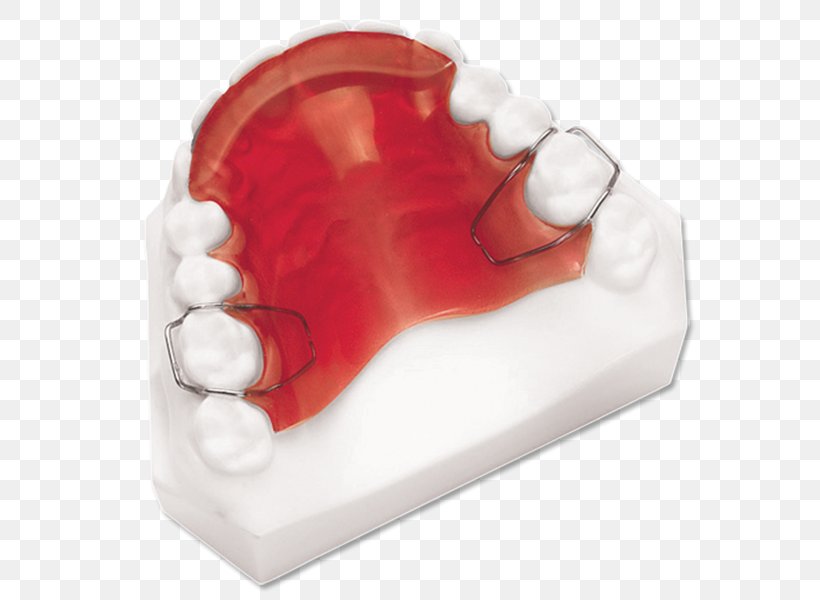 Twin Block Appliance Jaw Alaleuanluu Dental Braces Chin, PNG, 614x600px, Twin Block Appliance, Alaleuanluu, Chin, Dental Braces, Gums Download Free