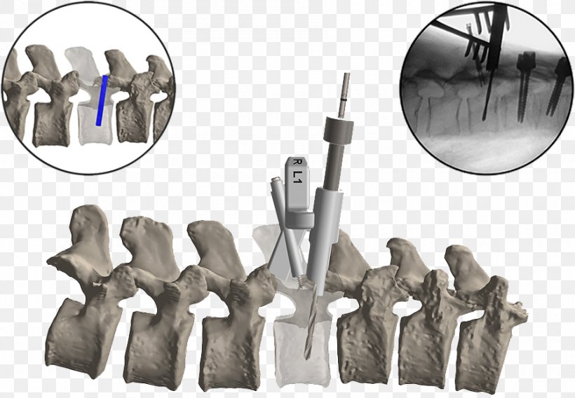 Vertebral Column Spinal Fusion Surgery Cervical Vertebrae Lumbar, PNG, 900x624px, 3d Printing, Vertebral Column, Anatomy, Cervical Vertebrae, Human Anatomy Download Free
