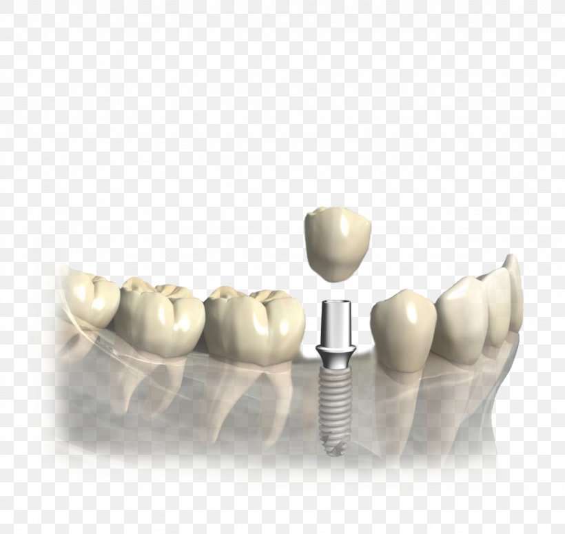 Tooth Dentistry Dental Implant Prosthesis, PNG, 1024x969px, Tooth, Abutment, Ceramic, Deciduous Teeth, Dental Implant Download Free