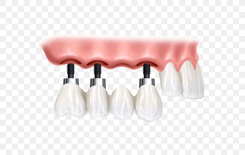 Dental Implant Dentistry Bridge, PNG, 786x518px, Dental Implant, Bowling Pin, Bridge, Crown, Dental Surgery Download Free
