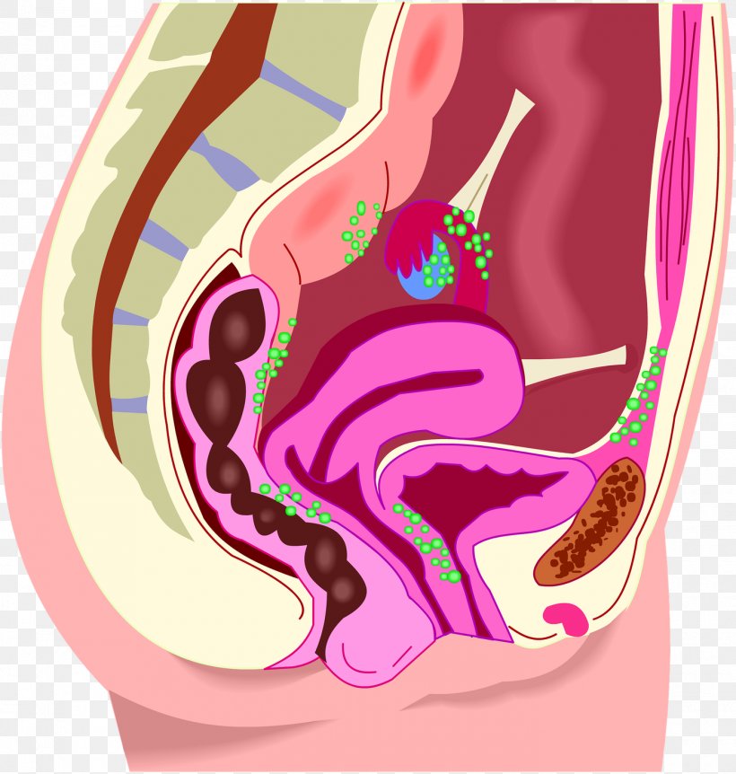 Endometriosis Menstruation Endometrium Disease Menstrual Cramps, PNG, 1400x1472px, Watercolor, Cartoon, Flower, Frame, Heart Download Free