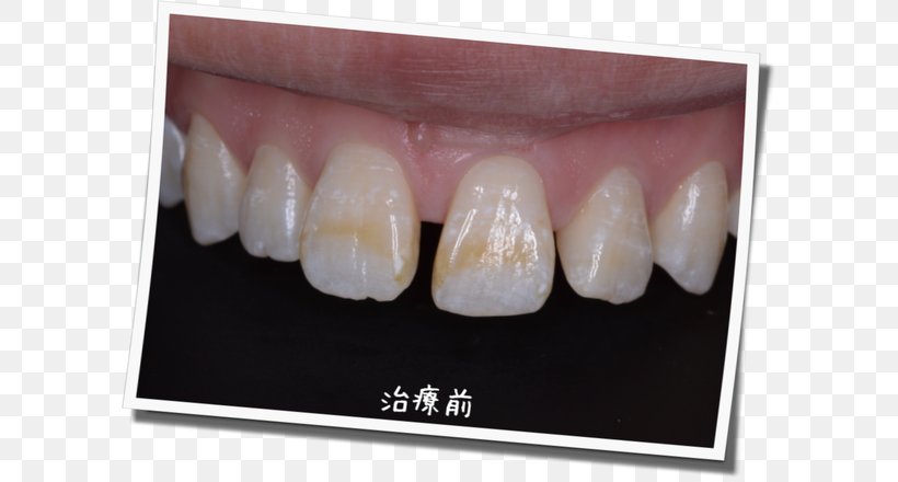 脱灰 Tooth Decay Tooth Enamel Therapy, PNG, 600x440px, Tooth Decay, Cosmetic Dentistry, Jaw, Mouth, Therapy Download Free