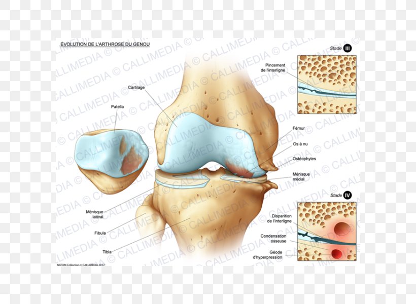 Bone Fracture Knee Disease Joint Tibia, PNG, 600x600px, Bone Fracture, Bone, Carpal Bones, Disease, Ear Download Free