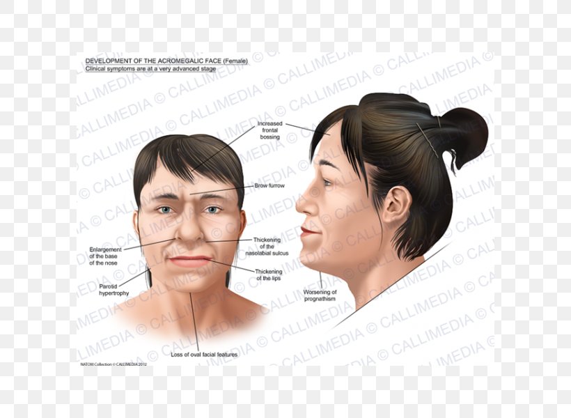 Acromegaly Face Gigantism Symptom Nose, PNG, 600x600px, Acromegaly, Cause, Cheek, Chin, Ear Download Free