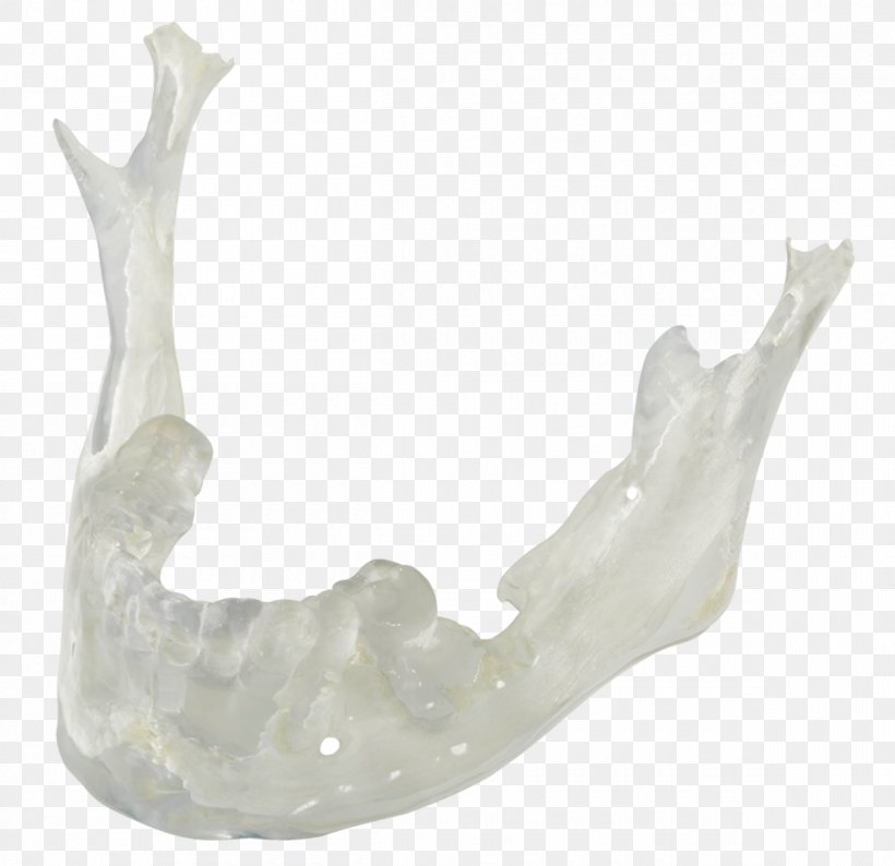 Dental Crafters, Inc. 3D Printing Dental Laboratory Dental Implant, PNG, 1200x1162px, 3d Computer Graphics, 3d Printing, Dental Crafters Inc, Biomodels, Bone Download Free