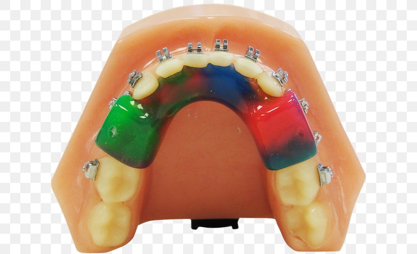 Tooth Twin Block Appliance Orthodontics Retainer Orthodontic Technology, PNG, 627x500px, Tooth, Anterior Teeth, Buford, Dental Braces, Finger Download Free