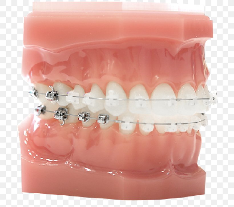 Tooth Damon System Dental Braces Dentistry ファミリエ歯科クリニック, PNG, 749x726px, Tooth, Adhesion, Apparaat, Child, Clinic Download Free