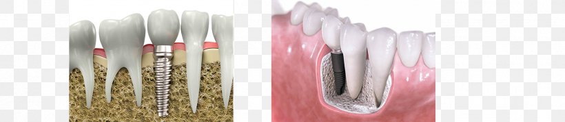 Prosthesis Prosthodontics Dentistry Dental Implant Tooth, PNG, 1749x381px, Prosthesis, Brush, Dental Implant, Dentistry, Health Download Free